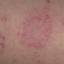33. Eczema on the Back Pictures