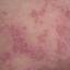34. Eczema on the Back Pictures