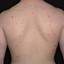 4. Eczema on the Back Pictures