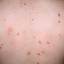 5. Eczema on the Back Pictures
