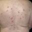 6. Eczema on the Back Pictures