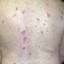 7. Eczema on the Back Pictures