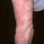 2. Eczema on Elbows Pictures