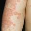 4. Eczema on Elbows Pictures