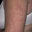 6. Eczema on Elbows Pictures