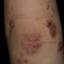8. Eczema on Elbows Pictures