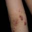 9. Eczema on Elbows Pictures