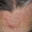 3. Eczema on forehead Pictures