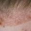 4. Eczema on forehead Pictures