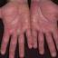 1. Eczema on the Palms Pictures