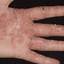 10. Eczema on the Palms Pictures