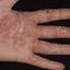 11. Eczema on the Palms Pictures