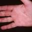 114. Eczema on the Palms Pictures
