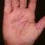 116. Eczema on the Palms Pictures
