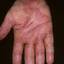 117. Eczema on the Palms Pictures