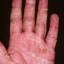 118. Eczema on the Palms Pictures