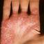 122. Eczema on the Palms Pictures