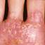 123. Eczema on the Palms Pictures