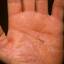 124. Eczema on the Palms Pictures