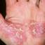 125. Eczema on the Palms Pictures