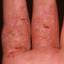127. Eczema on the Palms Pictures