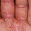 129. Eczema on the Palms Pictures