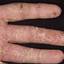 13. Eczema on the Palms Pictures