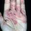 134. Eczema on the Palms Pictures