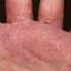 135. Eczema on the Palms Pictures