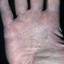 139. Eczema on the Palms Pictures