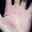 141. Eczema on the Palms Pictures