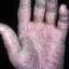 143. Eczema on the Palms Pictures