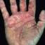 145. Eczema on the Palms Pictures