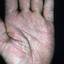 148. Eczema on the Palms Pictures