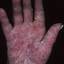 149. Eczema on the Palms Pictures