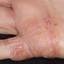 15. Eczema on the Palms Pictures