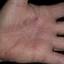 16. Eczema on the Palms Pictures