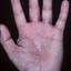 167. Eczema on the Palms Pictures