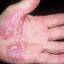 184. Eczema on the Palms Pictures
