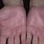 191. Eczema on the Palms Pictures