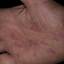 200. Eczema on the Palms Pictures