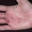 210. Eczema on the Palms Pictures