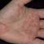 213. Eczema on the Palms Pictures