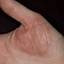 214. Eczema on the Palms Pictures
