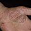 216. Eczema on the Palms Pictures