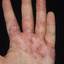 24. Eczema on the Palms Pictures