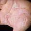 27. Eczema on the Palms Pictures