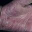 28. Eczema on the Palms Pictures