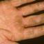 30. Eczema on the Palms Pictures