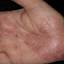 4. Eczema on the Palms Pictures